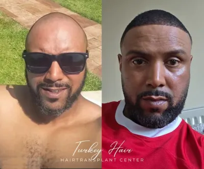 Q: Is an Afro hair transplant really different from a regular hair transplant?